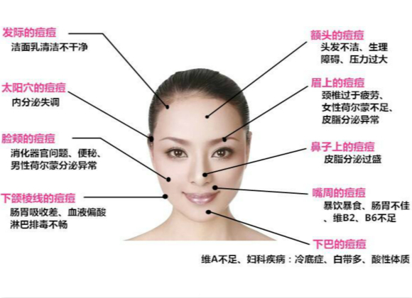 原來這些因素會(huì)導(dǎo)致長痘痘！你知道嗎?