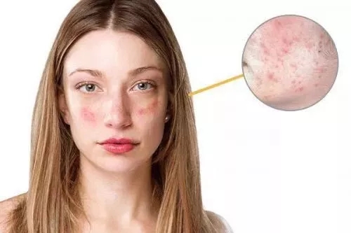 春季過(guò)敏不止你一個(gè) 預(yù)防要專業(yè)！