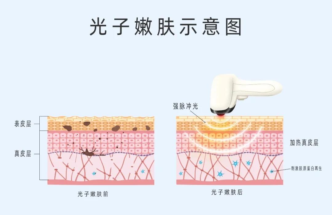 做好術(shù)后修復(fù)，拒絕“無效醫(yī)美”
